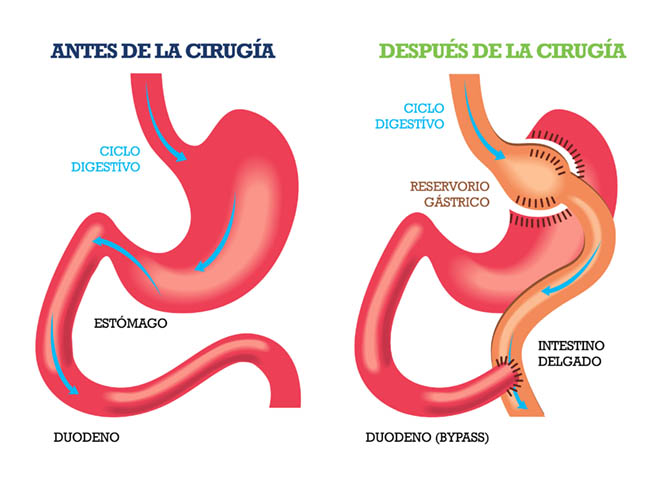 BypassGastrico