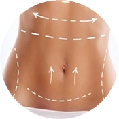 abdominoplastia