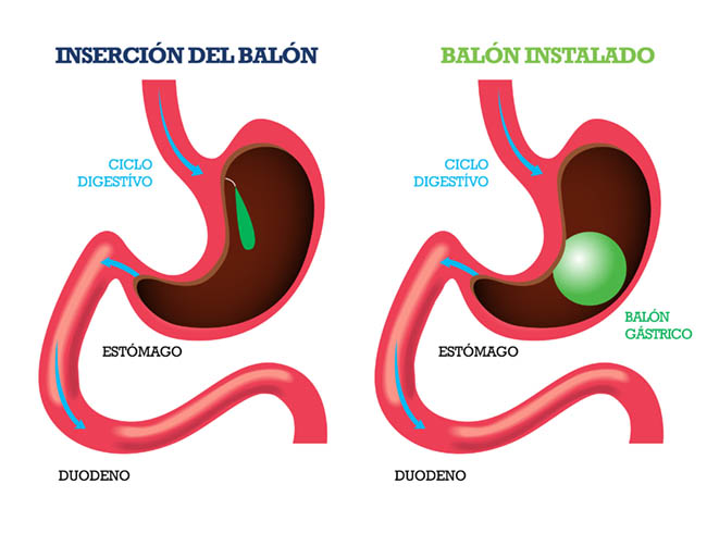 balongastrico